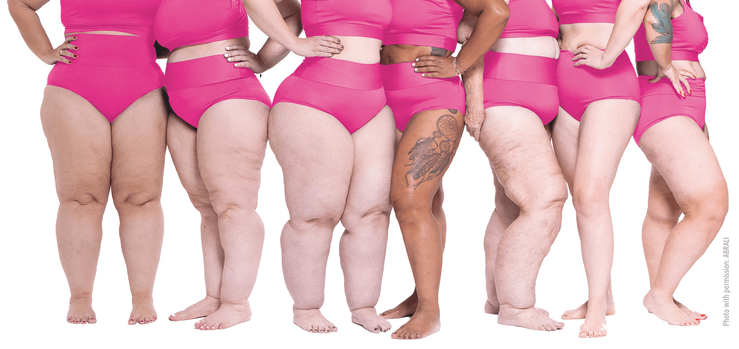 Lipoedema UK