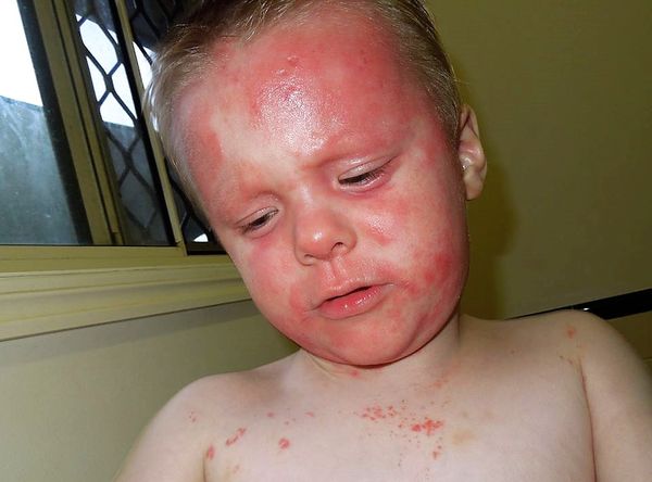 Eczema Support Australia Ltd